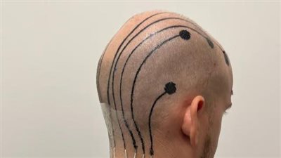 باحثون يستخدمون وشمًا مؤقتًا لفروة الرأس لتتبع الموجات الدماغية
