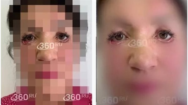 تجميل الجفون - أرشيفية