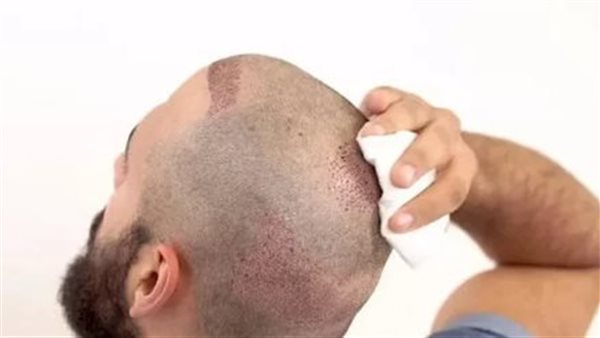 زراعة الشعر 