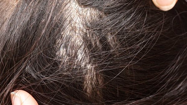 تفسير حلم وجود قمل