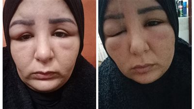 نفسيتي ادمرت ومش متقبلة شكلي.. فتاة تستغيث من صبغة شعر: جالي التهاب وعدوى