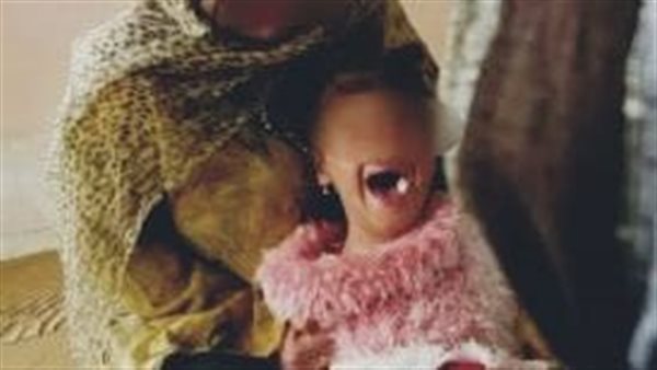 ختان اطفال - أرشيفية