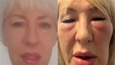 بريطانية تتعرض لمخاطر صحية نتيجة حقن الوجه بالبوتكس