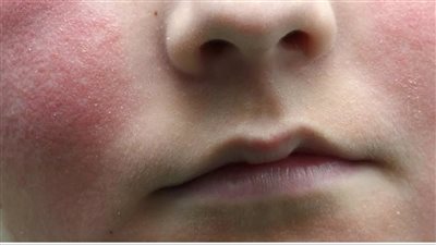 بعد انتشارها بـ المملكة المتحدة.. ما هي متلازمة الخد المصفوع؟ 