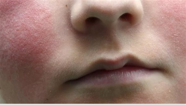 الخد المصفوع 