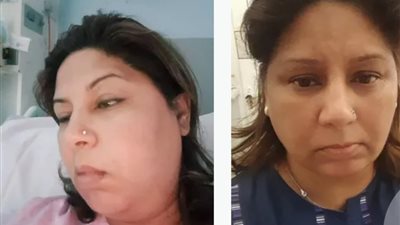 8500 جنيه إسترليني.. بريطانية تحصل على تعويض بسبب كسر في الفك خلال خلع ضرسها