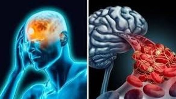  تجلط الجيوب الأنفية