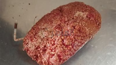 بعد عشر سنوات.. استخراج حصوات تحتوي على لولب من مثانة مريضة داخل مستشفى منوف العام 