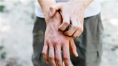 دراسة تكشف فوائد لحك الطفح الجلدي