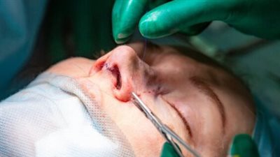 وفاة شاب خلال إجراء عملية تجميل بالأنف داخل مستشفى بأسيوط