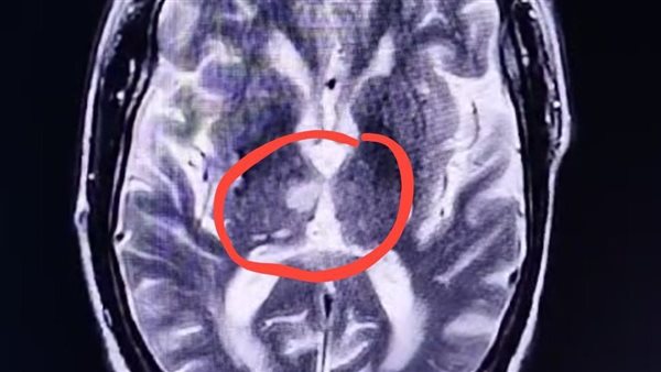 جلطة دماغية تؤثر