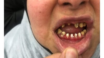 سيدة تتهم طبيب أسنان شهير بالتسبب في عجز دائم وتشوه بالوجه بعد عملية تجميلية فاشلة