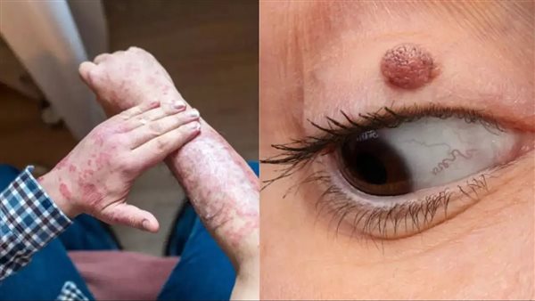 أعراض ارتفاع الكوليسترول