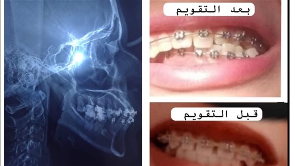 تقويم أسنان 