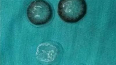 أطباء صينيون يعثرون على 5 عدسات لاصقة مفقودة خلف عين امرأة