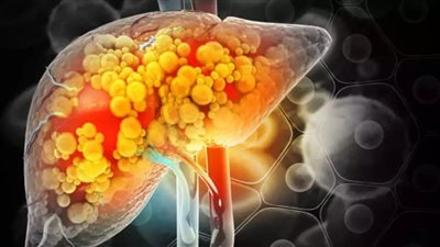 خبير من جامعة هارفارد يحذر من علامات خفية لمرض الكبد الدهني 