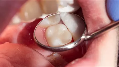 الأخطر على صحة الأسنان.. طبيب يحذر من المشروبات الغازية الخالية من السكر 