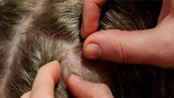 تفسير حلم قمل في