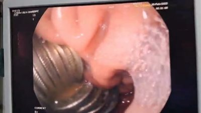 استخراج 13 جنيهًا معدنيًا من معدة طفل بمستشفى الأطفال بجامعة المنصورة