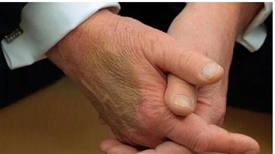 كدمة في يد ترامب تثير تكهنات حول حالته الصحية.. والبيت الأبيض يوضح