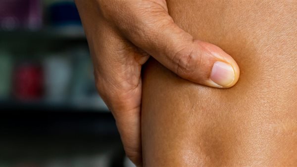  الوذمة الشحمية