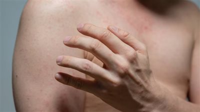 الصحة الأمريكية: أعداد إصابات الحصبة تجاوزت العام الماضي