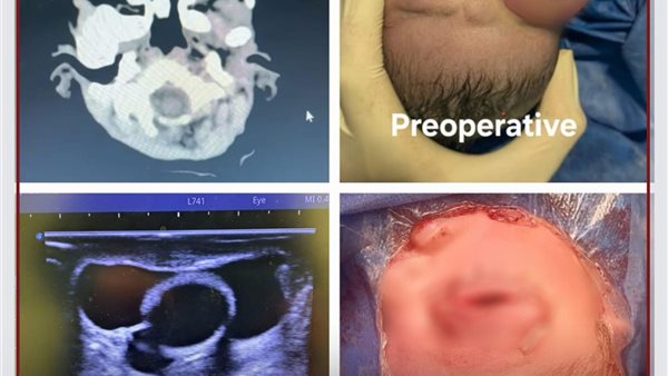 جانب من عين الرضيع