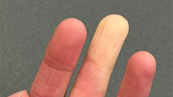 تغير لون الجلد