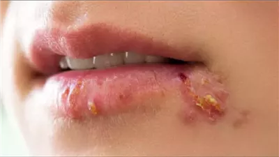 ما هو الهربس الفموي وأسباب إصابة الأطفال به وكيفية علاجه؟