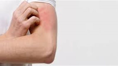 أبرزها وضع الكمادات الباردة.. نصائح لتخفيف أعراض التهاب الجلد التأتبي