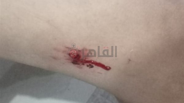 إصابة 59 شخصًا بعقر