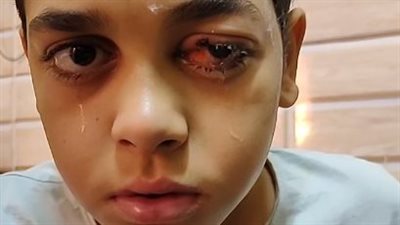 نزيف وتهتك.. صبي أُصيب في عينه بسبب الألعاب النارية بالوادي الجديد: الصاروخ فرقع في وشي| بث مباشر