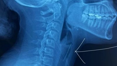 عادة تفعلها المحجبات تتسبب في اختناق فتاة مغربية