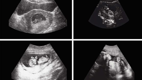 صورة مقطعية للطفلة