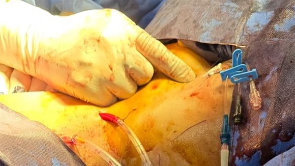 جانب من الجراحة 