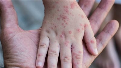 يصيب اليد والقدم والفم.. أطباء يحذرون من فيروس شديد العدوى في أمريكا