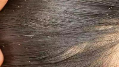 تفسير حلم نزع القمل من الشعر للمتزوجة.. هذا ما يوضحه ابن سيرين