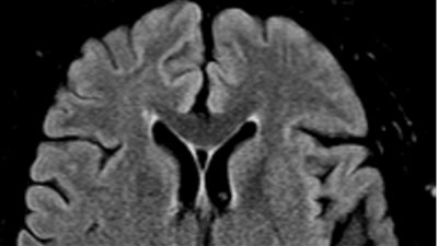 فقدان للكلام وشلل نصفي.. حالة نادرة تصيب مريضة بعد التخدير في أمريكا 