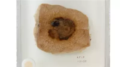 اختبار دم جديد يتنبأ بدقة بعودة سرطان الجلد بعد الجراحة