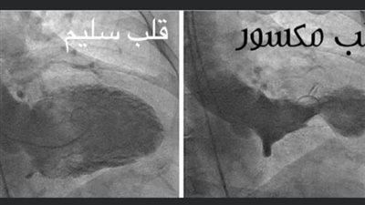 الدكتور جمال شعبان يحذر من تأثير الحزن على صحة القلب