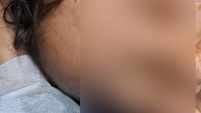 أصيبوا بحساسية شديدة.. أم بكفر الشيخ تضع لأبنائها حناء في العين بدلًا من الكحل| بث مباشر 