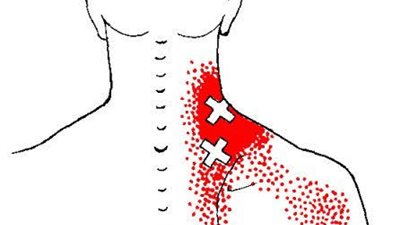 تَحدث نتيجة الإفراط في استخدام العضلات.. ما هي العقد العضلية؟ 