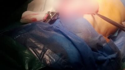 لديه 3 فصوص بالرئة.. إنقاذ حياة رضيع يعاني من عيب خلقي بمستشفى قنا الجامعي