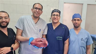 استئصال طحال متضخم يزن 2 كيلو من مريضة بمستشفى أسيوط العام