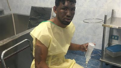  أحد مصابي انفجار خط غاز طريق الواحات في حالة حرجة بمستشفى إمبابة.. والأسرة تطالب بنقله لمستشفى حروق