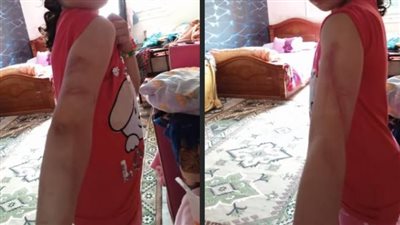 فتاة تدعي ضرب وحرق زوج شقيقتها الراحلة لصغيرته: بيطفي السجاير في جسمها 