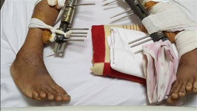 استغاثة من الأقصر: طالب إعدادي يعاني من الإصابة بعد حادث دراجة نارية.. وأسرته تطالب بلجنة خاصة للامتحان