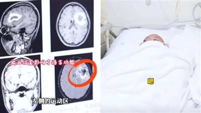 فقدت القدرة على التحدث بالإنجليزية فجأة.. حالة غامضة تثير دهشة الأطباء في الصين