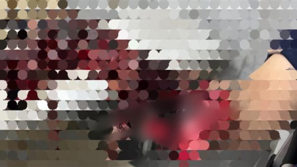 جانب من الجراحة 