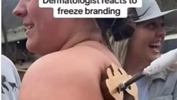 كي الجلد بالتبريد